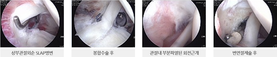 상부관절외순 SLAP병변, 봉합 수술 후, 관절내 부분파열된 회전근개, 변연절제술 후의 이미지