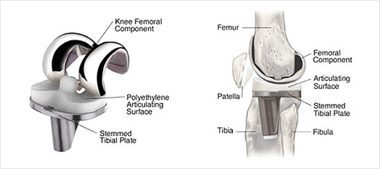 Knee Femoral Component Polyethylene Articulating Surface. Femur Femoral Component Articulating Surface Patella Stemmed Tibial Plate Tibia Fibula